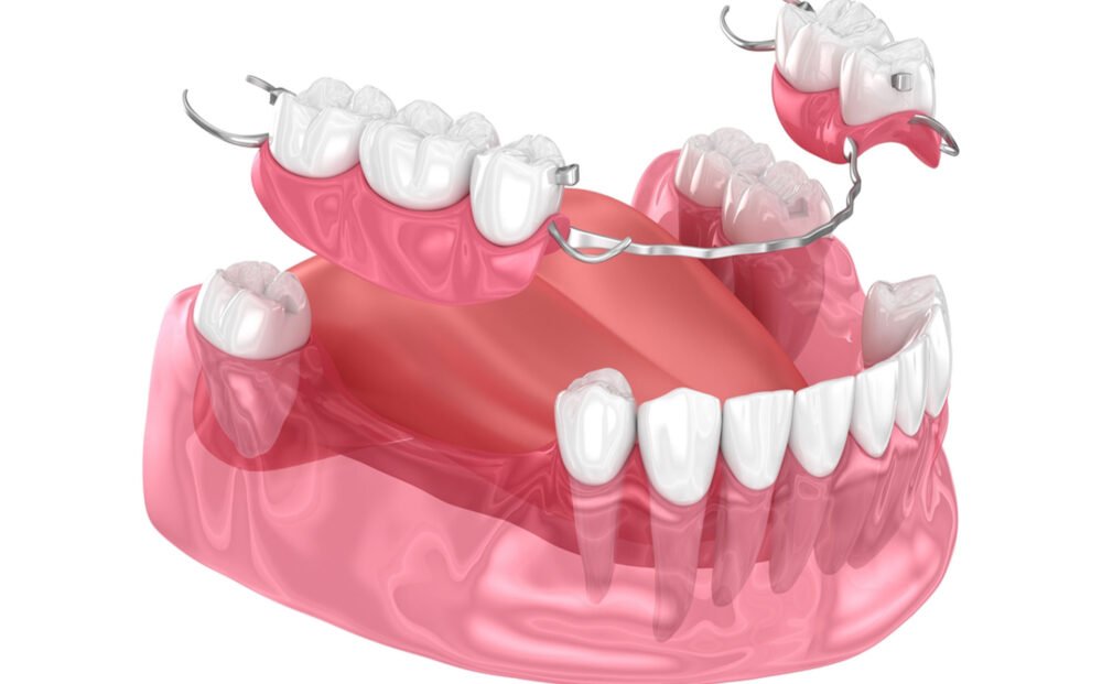 fixed-partial-denture