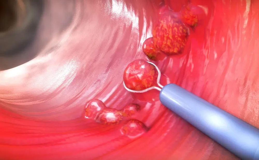 oral-cancer-biopsy