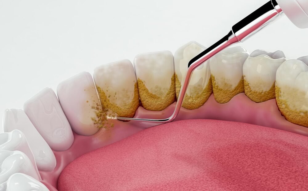 teeth-scalling-and-polishing-2
